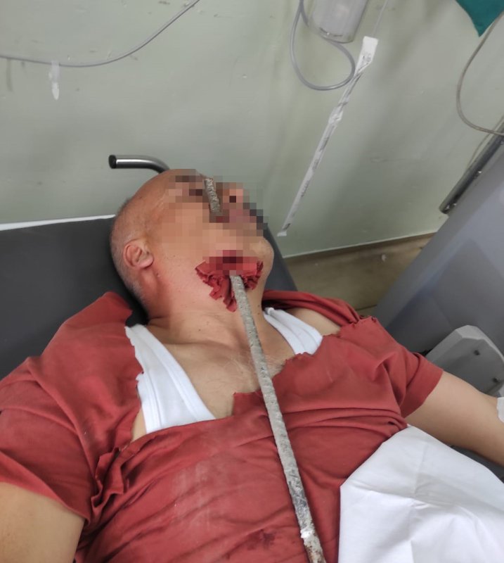 İnşaat işçisinin yüzüne demir saplandı