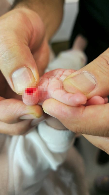 Serum çıkarma işlemi esnasında sargıyla birlikte bebeğin parmağı kesildi