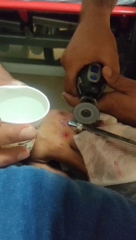 Acil serviste yüzük çıkarma operasyonu