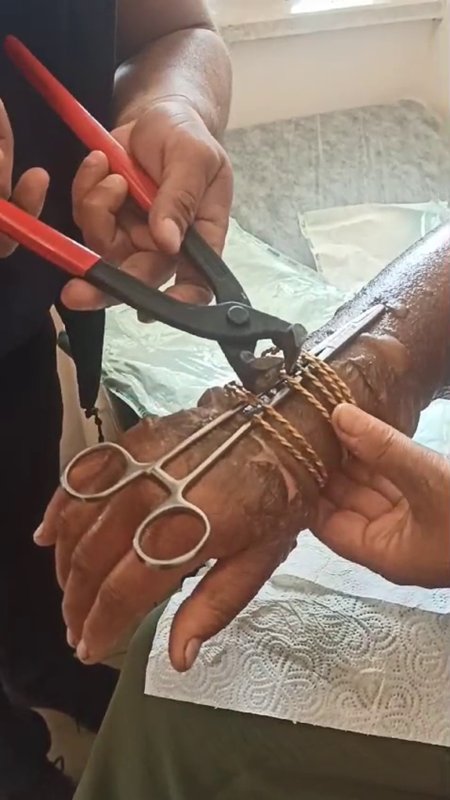 HATAY (İHA) - Hatay’da kolu yanan kadının bilezikleri kesilerek çıkarıldı.