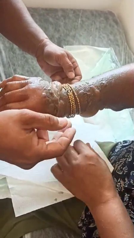 HATAY (İHA) - Hatay’da kolu yanan kadının bilezikleri kesilerek çıkarıldı.