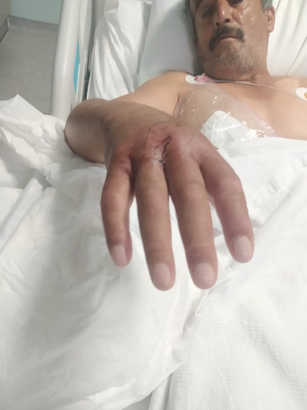 Narenciye topladığı esnada engerek ısıran çiftçi, hayata tutunmayı başardı - Çiftçi Gani Ayiler: “Elimi hemen bilek kısmından bağladılar eğer bileğimden bağlamamış olsalardı yılanın zehri tüm vücuduma dağılırdı” (Fotoğraflı) Esma Kural - Ogün Aslan HATAY (İHA) - Hatay'da narenciye hasadı yaptığı esnada engerek yılanının saldırısına uğrayan çiftçi Gani Ayiler, saldırının üzerinden 10 gün geçmesine rağmen acı çekmeye devam ediyor. Yaşadığı korku dolu anları anlatan Ayiler, elini bileğinden bağlamasının kendini hayata tutundurduğunu söyledi. Dörtyol ilçesi Yeşilköy Mahallesi'nde yaşayan Gani Ayiler isimli çiftçi, narenciye bahçesinde hasat yaptığı esnada engerek yılanı tarafından sokulmuştu. Ayiler, yılan saldırısı sonrası bileğinden bağlanarak kısa sürede tedavi altına alındı. Yoğun bakımdaki sürecin ardından taburcu edilen Ayiler, olayın üzerinden 10 gün geçmesine rağmen kolunu oynatamıyor ve ağrıları devam ediyor. Kendisini ısıran engerek yılanı ailesi tarafından öldürülen Ayiler, yaşadıklarını anlattı. “Elimi hemen bilek kısmından bağladılar eğer bileğimden bağlamamış olsalardı yılanın zehri tüm vücuduma dağılırdı” Engerek saldırısı sonrası yaşadıklarını anlatan 53 yaşındaki Gani Ayiler, "Narenciye hasadı yaptığımız yer biraz karanlıktı. Yılanı gördüm elimi uzattım ve bir anda elimi ısırdı. Isırması sonucunda aileme seslendim, elimi hemen bilek kısmından bağladılar eğer bileğimden bağlamamış olsalardı yılanın zehri tüm vücuduma dağılırdı. Doktor bey de 'iyi ki bilek kısmından bağlamışlar yoksa zehir tüm vücuda yayılırmış' dedi. Engerek yılanı ısırması sonrasında hem uyuşma hem de sancı çok fazla vardı, yılanın ısırması mermi sıkılmış gibiydi. Elimi bağladıkları için sadece elim uyuştu eğer bağlanmasaydı tüm vücudum uyuşurdu. Yılan soktuktan sonra ben kendimden geçtim ve beni zorlukla hastaneye yetiştirdiler. Hastanede hemen yoğun bakıma aldılar. Beş gün yoğun bakımda kaldım" dedi. “Elimi uzatmamla elimi ısırması bir anda oldu” Yılanın saldırısının üzerinden 10 gün geçmesine rağmen hala ağrılarının olduğunu ve kolunu oynatamadığını dile getiren Ayiler, “Ağrı halen devam ediyor, elimi kaldırıp indiremiyorum. Dünyadaki en zehirli yılanı engerekmiş. Elimi uzatmamla elimi ısırması bir anda oldu. Yılanın ısırmasıyla bayağı bir ağrı yaptı ve yerde buldukları iple elimi hemen bağladılar. Elimi eğer bağlamamış olsaydılar ne kalp kalırdı ne ben kalırdım. 9-10 gün oldu işe gidemiyorum. Maddi durumum da fazla yok. Altı tane çocuğum var. Kalp rahatsızlığı var bende ve kalbimden üç sefer anjiyo oldum” ifadelerini kullandı.