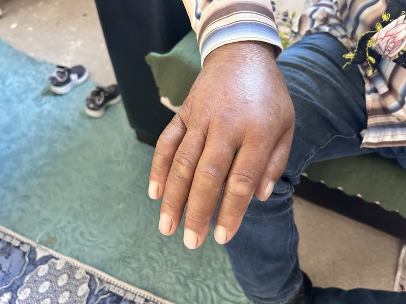 Narenciye topladığı esnada engerek ısıran çiftçi, hayata tutunmayı başardı - Çiftçi Gani Ayiler: “Elimi hemen bilek kısmından bağladılar eğer bileğimden bağlamamış olsalardı yılanın zehri tüm vücuduma dağılırdı” (Fotoğraflı) Esma Kural - Ogün Aslan HATAY (İHA) - Hatay'da narenciye hasadı yaptığı esnada engerek yılanının saldırısına uğrayan çiftçi Gani Ayiler, saldırının üzerinden 10 gün geçmesine rağmen acı çekmeye devam ediyor. Yaşadığı korku dolu anları anlatan Ayiler, elini bileğinden bağlamasının kendini hayata tutundurduğunu söyledi. Dörtyol ilçesi Yeşilköy Mahallesi'nde yaşayan Gani Ayiler isimli çiftçi, narenciye bahçesinde hasat yaptığı esnada engerek yılanı tarafından sokulmuştu. Ayiler, yılan saldırısı sonrası bileğinden bağlanarak kısa sürede tedavi altına alındı. Yoğun bakımdaki sürecin ardından taburcu edilen Ayiler, olayın üzerinden 10 gün geçmesine rağmen kolunu oynatamıyor ve ağrıları devam ediyor. Kendisini ısıran engerek yılanı ailesi tarafından öldürülen Ayiler, yaşadıklarını anlattı. “Elimi hemen bilek kısmından bağladılar eğer bileğimden bağlamamış olsalardı yılanın zehri tüm vücuduma dağılırdı” Engerek saldırısı sonrası yaşadıklarını anlatan 53 yaşındaki Gani Ayiler, "Narenciye hasadı yaptığımız yer biraz karanlıktı. Yılanı gördüm elimi uzattım ve bir anda elimi ısırdı. Isırması sonucunda aileme seslendim, elimi hemen bilek kısmından bağladılar eğer bileğimden bağlamamış olsalardı yılanın zehri tüm vücuduma dağılırdı. Doktor bey de 'iyi ki bilek kısmından bağlamışlar yoksa zehir tüm vücuda yayılırmış' dedi. Engerek yılanı ısırması sonrasında hem uyuşma hem de sancı çok fazla vardı, yılanın ısırması mermi sıkılmış gibiydi. Elimi bağladıkları için sadece elim uyuştu eğer bağlanmasaydı tüm vücudum uyuşurdu. Yılan soktuktan sonra ben kendimden geçtim ve beni zorlukla hastaneye yetiştirdiler. Hastanede hemen yoğun bakıma aldılar. Beş gün yoğun bakımda kaldım" dedi. “Elimi uzatmamla elimi ısırması bir anda oldu” Yılanın saldırısının üzerinden 10 gün geçmesine rağmen hala ağrılarının olduğunu ve kolunu oynatamadığını dile getiren Ayiler, “Ağrı halen devam ediyor, elimi kaldırıp indiremiyorum. Dünyadaki en zehirli yılanı engerekmiş. Elimi uzatmamla elimi ısırması bir anda oldu. Yılanın ısırmasıyla bayağı bir ağrı yaptı ve yerde buldukları iple elimi hemen bağladılar. Elimi eğer bağlamamış olsaydılar ne kalp kalırdı ne ben kalırdım. 9-10 gün oldu işe gidemiyorum. Maddi durumum da fazla yok. Altı tane çocuğum var. Kalp rahatsızlığı var bende ve kalbimden üç sefer anjiyo oldum” ifadelerini kullandı.