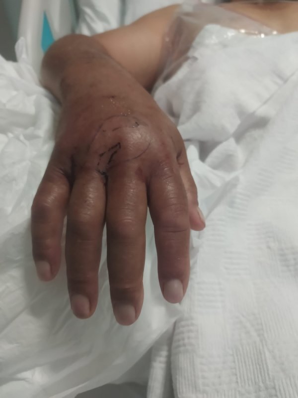 Narenciye topladığı esnada engerek ısıran çiftçi, hayata tutunmayı başardı - Çiftçi Gani Ayiler: “Elimi hemen bilek kısmından bağladılar eğer bileğimden bağlamamış olsalardı yılanın zehri tüm vücuduma dağılırdı” (Fotoğraflı) Esma Kural - Ogün Aslan HATAY (İHA) - Hatay'da narenciye hasadı yaptığı esnada engerek yılanının saldırısına uğrayan çiftçi Gani Ayiler, saldırının üzerinden 10 gün geçmesine rağmen acı çekmeye devam ediyor. Yaşadığı korku dolu anları anlatan Ayiler, elini bileğinden bağlamasının kendini hayata tutundurduğunu söyledi. Dörtyol ilçesi Yeşilköy Mahallesi'nde yaşayan Gani Ayiler isimli çiftçi, narenciye bahçesinde hasat yaptığı esnada engerek yılanı tarafından sokulmuştu. Ayiler, yılan saldırısı sonrası bileğinden bağlanarak kısa sürede tedavi altına alındı. Yoğun bakımdaki sürecin ardından taburcu edilen Ayiler, olayın üzerinden 10 gün geçmesine rağmen kolunu oynatamıyor ve ağrıları devam ediyor. Kendisini ısıran engerek yılanı ailesi tarafından öldürülen Ayiler, yaşadıklarını anlattı. “Elimi hemen bilek kısmından bağladılar eğer bileğimden bağlamamış olsalardı yılanın zehri tüm vücuduma dağılırdı” Engerek saldırısı sonrası yaşadıklarını anlatan 53 yaşındaki Gani Ayiler, "Narenciye hasadı yaptığımız yer biraz karanlıktı. Yılanı gördüm elimi uzattım ve bir anda elimi ısırdı. Isırması sonucunda aileme seslendim, elimi hemen bilek kısmından bağladılar eğer bileğimden bağlamamış olsalardı yılanın zehri tüm vücuduma dağılırdı. Doktor bey de 'iyi ki bilek kısmından bağlamışlar yoksa zehir tüm vücuda yayılırmış' dedi. Engerek yılanı ısırması sonrasında hem uyuşma hem de sancı çok fazla vardı, yılanın ısırması mermi sıkılmış gibiydi. Elimi bağladıkları için sadece elim uyuştu eğer bağlanmasaydı tüm vücudum uyuşurdu. Yılan soktuktan sonra ben kendimden geçtim ve beni zorlukla hastaneye yetiştirdiler. Hastanede hemen yoğun bakıma aldılar. Beş gün yoğun bakımda kaldım" dedi. “Elimi uzatmamla elimi ısırması bir anda oldu” Yılanın saldırısının üzerinden 10 gün geçmesine rağmen hala ağrılarının olduğunu ve kolunu oynatamadığını dile getiren Ayiler, “Ağrı halen devam ediyor, elimi kaldırıp indiremiyorum. Dünyadaki en zehirli yılanı engerekmiş. Elimi uzatmamla elimi ısırması bir anda oldu. Yılanın ısırmasıyla bayağı bir ağrı yaptı ve yerde buldukları iple elimi hemen bağladılar. Elimi eğer bağlamamış olsaydılar ne kalp kalırdı ne ben kalırdım. 9-10 gün oldu işe gidemiyorum. Maddi durumum da fazla yok. Altı tane çocuğum var. Kalp rahatsızlığı var bende ve kalbimden üç sefer anjiyo oldum” ifadelerini kullandı.