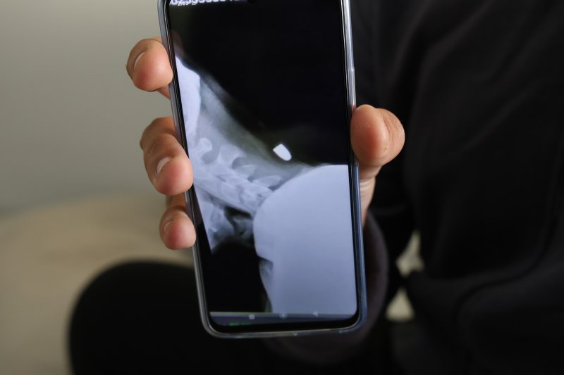 Ensesine yorgun mermi isabet eden 18 yaşındaki genç, 2 santimle ölümden döndü