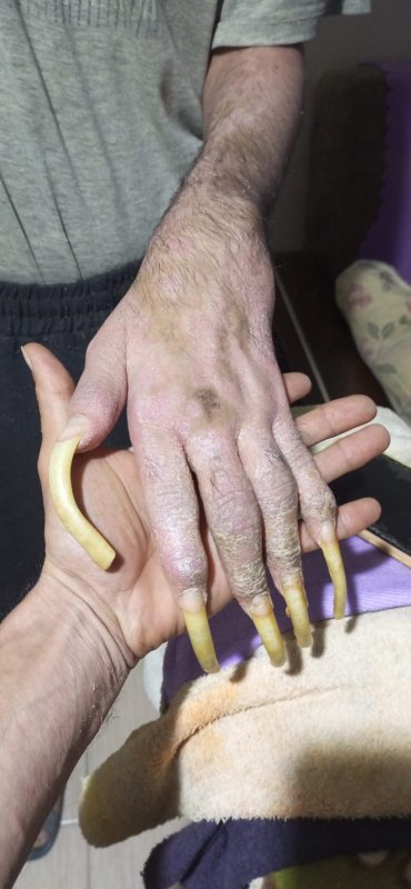 Telefon bağımlısı genç: 3 yıldır evden dışarı ne tek bir adım attı ne de beslenmek dışında bir şey yaptı - Eve ve sanal dünyaya bağımlı hale gelen genç, annesine acı çektiriyor (Fotoğraflı) Ramazan İlın HATAY (İHA) - Hatay'da 3 yıla yakın süredir evden çıkmayarak sadece telefonla ve bilgisayarla oynayan 23 yaşındaki genç, sanal dünyaya bağımlı hale geldi. Evladının beslenmek dışında hiçbir şey yapmamasına üzülen anne, evladının eski günlerine dönmesini istiyor. Kahramanmaraş merkezli depremlerde evini kaybeden ve Defne ilçesinde yaşamlarını sürdüren 50 yaşındaki anne Semra Özbay ve 23 yaşındaki oğlu Barış Özbay, yaşadıkları depremin ardından hayata birlikte tutunarak yaşamlarını sürdürüyor. Depremde hem evlerini hem yakınlarını kaybeden aile, üç yıldır zorlu bir süreçle mücadele ediyor. Depremin ardından yaşama hevesini kaybeden ve okuduğu üniversiteyi yarıda bırakarak sürekli bilgisayar ve cep telefonuyla oynamaya başlayan Barış Özbay, sanal dünyaya bağımlı hale geldi. Yaşamak için gerekli ihtiyaçlarını gideren genç adam; ne duş alıyor ne de tırnaklarını kesmek gibi özel gereksinimlerini yerini getiriyor. Evin dışına 3 yıla yakın süredir tek adım dahi atmayan Barış'ın annesi Semra Özbay, evladı için her gün acı çekiyor. Telefonla ve bilgisayarla oynamaktan boynunu dahi çeviremeyen Barış'ın yeniden hayata tutunması için acılı annesi destek bekliyor. "Hiçbir şey yapmak istemediğim için banyo da yapmak istemiyorum, elimde olsa tuvalete de gitmem ve yemek de yemem ve onları mecbur olduğum için yapıyorum" Gün boyunca evden çıkmadığını sadece yaşamak için gerekli şeyleri yapmak istediğini söyleyen Barış Özbay, süreci atlatmak için tedavi görmek istemediğini belirterek, "Genelde uyanıyorum, tuvaletimi yapıyorum, yemeği yiyorum mecbur olduğum için yoksa onları yapmam. Sonra oturuyorum ve telefonla oynarım. Duvarları izliyorum ve akşam olmasını bekliyorum sonra uyuyorum. Depremden 2 ay önce kendimi eve kapattım. Ondan önce de yavaş yavaş hayata karşı bıkkınlığım başlıyordu. Üniversitede lojistik bölümü okuyordum. Hiçbir şey yapmak istemediğim için banyo da yapmak istemiyorum. Elimde olsa tuvalete de gitmem ve yemek de yemem. Onları mecbur olduğum için yapıyorum. Depremden önce banyo yapıyordum ama şimdi banyo yapmak istemiyorum. Hayalim yok. Hiçbir şey olmasını istemiyorum. Kendileri çabalıyorlar ama ben de düzelmeyi ve yardımı istemiyorum. Ben dışarı çıkıp bir şeyler yapmak istemiyorum. Evde oturacağım. Tırnaklarım daha da uzundu ama zorla kestiler. Kısacası hayat mükemmel değil. İnsanlar hayat inişli çıkışlı güzel derler ya bana göre tam tersi oluyor. Hayatın inişli çıkışlı işleri güzel değil ve istemiyorum" dedi. "Banyo yapmayı bıraktı, her şeyi bıraktı, kendini eve kapattı, sadece telefon ve bilgisayarla oynuyor" Evladının 3 yıldır duş almadığını ve evden çıkmadığını söyleyen Semra Özbay, bilgisayar ve telefon bağımlısı olan Barış için acı çektiğini belirterek "Oğlum Barış Özbay 23 yaşında, depremde evimiz yıkıldı. Depremde nenesini kaybetti ve arkadaşları dağıldı. Oğlum, çalışkan bir gençti, okulda birinci oluyordu. Herkesle çok iyi anlaşıyordu ve herkes onunla gurur duyuyordu. Kendisinin egzama hastalığı da var, 3 yıldır banyo yapmıyor. Bir anne olarak ne olursa olsun bırakamıyorum. Depremden önce banyo konusunda çok iyiydi, önceden banyo yaptırmadığım zaman bana kızıyordu. Depremden sonra değişti. Banyo yapmayı bıraktı, her şeyi bıraktı, kendini eve kapattı, sadece telefon ve bilgisayarla oynuyor. Arkadaşlarıyla nadir konuşuyor ama benimle konuşmuyor. Depremden önce oğlum iyiydi ama depremden sonra bayağı değişti. Eve kapattı kendini ve ölmek istediğini söylüyor. Ona banyonu yap diyorum, 'ben öleceğim' diyor. Bazen 'ya sen ölürsün ya da ben ölürüm. Başka kurtuluşu yok.' Eskisi gibi benimle konuşmuyor ve bana anne demiyor. Bu şekilde zorlanıyorum. Oğlumun eski anılarına dönmek için eski fotoğraflarına bakıyorum, kendimi bu şekilde avutuyorum. Eşim benim için öldü, başka çocuğum da yok. 3 yıldır oğluma bu şekilde bakıyorum. İşkencelerine rağmen oğlum deyip bırakamıyorum. Bazen kavga ediyoruz ama yine de onu anlamaya çalışıyorum. Yetkililerden yardım istiyorum. Oğlumu hastaneye götürüp tedavi olmasını istiyorum" ifadelerini kullandı.