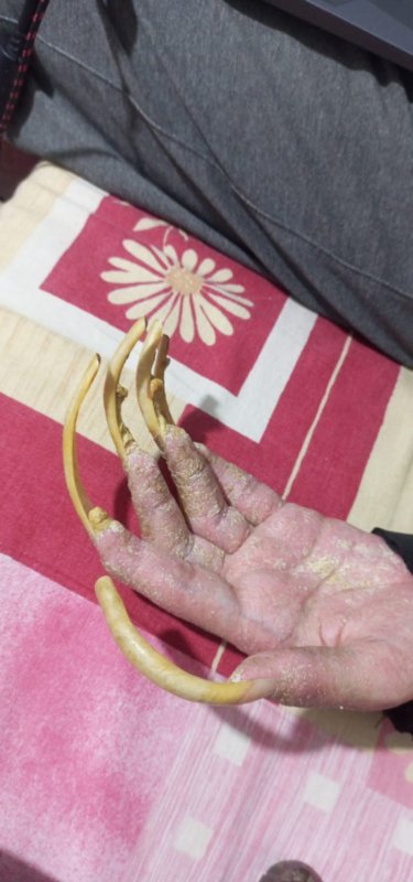 Telefon bağımlısı genç: 3 yıldır evden dışarı ne tek bir adım attı ne de beslenmek dışında bir şey yaptı - Eve ve sanal dünyaya bağımlı hale gelen genç, annesine acı çektiriyor (Fotoğraflı) Ramazan İlın HATAY (İHA) - Hatay'da 3 yıla yakın süredir evden çıkmayarak sadece telefonla ve bilgisayarla oynayan 23 yaşındaki genç, sanal dünyaya bağımlı hale geldi. Evladının beslenmek dışında hiçbir şey yapmamasına üzülen anne, evladının eski günlerine dönmesini istiyor. Kahramanmaraş merkezli depremlerde evini kaybeden ve Defne ilçesinde yaşamlarını sürdüren 50 yaşındaki anne Semra Özbay ve 23 yaşındaki oğlu Barış Özbay, yaşadıkları depremin ardından hayata birlikte tutunarak yaşamlarını sürdürüyor. Depremde hem evlerini hem yakınlarını kaybeden aile, üç yıldır zorlu bir süreçle mücadele ediyor. Depremin ardından yaşama hevesini kaybeden ve okuduğu üniversiteyi yarıda bırakarak sürekli bilgisayar ve cep telefonuyla oynamaya başlayan Barış Özbay, sanal dünyaya bağımlı hale geldi. Yaşamak için gerekli ihtiyaçlarını gideren genç adam; ne duş alıyor ne de tırnaklarını kesmek gibi özel gereksinimlerini yerini getiriyor. Evin dışına 3 yıla yakın süredir tek adım dahi atmayan Barış'ın annesi Semra Özbay, evladı için her gün acı çekiyor. Telefonla ve bilgisayarla oynamaktan boynunu dahi çeviremeyen Barış'ın yeniden hayata tutunması için acılı annesi destek bekliyor. "Hiçbir şey yapmak istemediğim için banyo da yapmak istemiyorum, elimde olsa tuvalete de gitmem ve yemek de yemem ve onları mecbur olduğum için yapıyorum" Gün boyunca evden çıkmadığını sadece yaşamak için gerekli şeyleri yapmak istediğini söyleyen Barış Özbay, süreci atlatmak için tedavi görmek istemediğini belirterek, "Genelde uyanıyorum, tuvaletimi yapıyorum, yemeği yiyorum mecbur olduğum için yoksa onları yapmam. Sonra oturuyorum ve telefonla oynarım. Duvarları izliyorum ve akşam olmasını bekliyorum sonra uyuyorum. Depremden 2 ay önce kendimi eve kapattım. Ondan önce de yavaş yavaş hayata karşı bıkkınlığım başlıyordu. Üniversitede lojistik bölümü okuyordum. Hiçbir şey yapmak istemediğim için banyo da yapmak istemiyorum. Elimde olsa tuvalete de gitmem ve yemek de yemem. Onları mecbur olduğum için yapıyorum. Depremden önce banyo yapıyordum ama şimdi banyo yapmak istemiyorum. Hayalim yok. Hiçbir şey olmasını istemiyorum. Kendileri çabalıyorlar ama ben de düzelmeyi ve yardımı istemiyorum. Ben dışarı çıkıp bir şeyler yapmak istemiyorum. Evde oturacağım. Tırnaklarım daha da uzundu ama zorla kestiler. Kısacası hayat mükemmel değil. İnsanlar hayat inişli çıkışlı güzel derler ya bana göre tam tersi oluyor. Hayatın inişli çıkışlı işleri güzel değil ve istemiyorum" dedi. "Banyo yapmayı bıraktı, her şeyi bıraktı, kendini eve kapattı, sadece telefon ve bilgisayarla oynuyor" Evladının 3 yıldır duş almadığını ve evden çıkmadığını söyleyen Semra Özbay, bilgisayar ve telefon bağımlısı olan Barış için acı çektiğini belirterek "Oğlum Barış Özbay 23 yaşında, depremde evimiz yıkıldı. Depremde nenesini kaybetti ve arkadaşları dağıldı. Oğlum, çalışkan bir gençti, okulda birinci oluyordu. Herkesle çok iyi anlaşıyordu ve herkes onunla gurur duyuyordu. Kendisinin egzama hastalığı da var, 3 yıldır banyo yapmıyor. Bir anne olarak ne olursa olsun bırakamıyorum. Depremden önce banyo konusunda çok iyiydi, önceden banyo yaptırmadığım zaman bana kızıyordu. Depremden sonra değişti. Banyo yapmayı bıraktı, her şeyi bıraktı, kendini eve kapattı, sadece telefon ve bilgisayarla oynuyor. Arkadaşlarıyla nadir konuşuyor ama benimle konuşmuyor. Depremden önce oğlum iyiydi ama depremden sonra bayağı değişti. Eve kapattı kendini ve ölmek istediğini söylüyor. Ona banyonu yap diyorum, 'ben öleceğim' diyor. Bazen 'ya sen ölürsün ya da ben ölürüm. Başka kurtuluşu yok.' Eskisi gibi benimle konuşmuyor ve bana anne demiyor. Bu şekilde zorlanıyorum. Oğlumun eski anılarına dönmek için eski fotoğraflarına bakıyorum, kendimi bu şekilde avutuyorum. Eşim benim için öldü, başka çocuğum da yok. 3 yıldır oğluma bu şekilde bakıyorum. İşkencelerine rağmen oğlum deyip bırakamıyorum. Bazen kavga ediyoruz ama yine de onu anlamaya çalışıyorum. Yetkililerden yardım istiyorum. Oğlumu hastaneye götürüp tedavi olmasını istiyorum" ifadelerini kullandı.