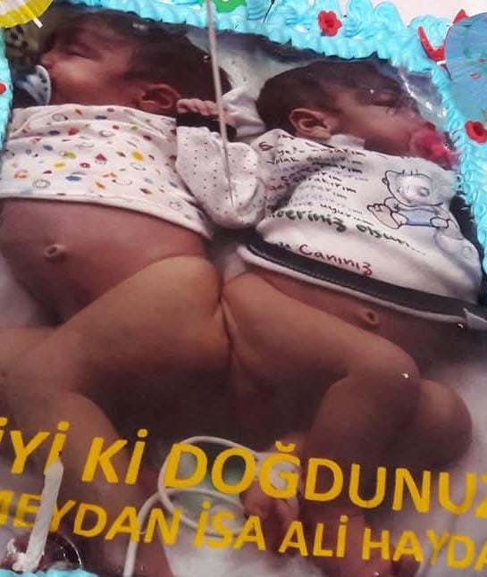 Siyam İkizlerinden Ali Haydar Hayatını Kaybetti