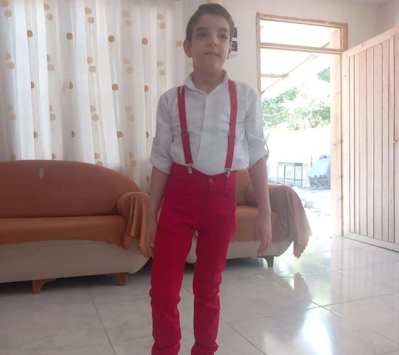 Siyam İkizlerinden Ali Haydar Hayatını Kaybetti