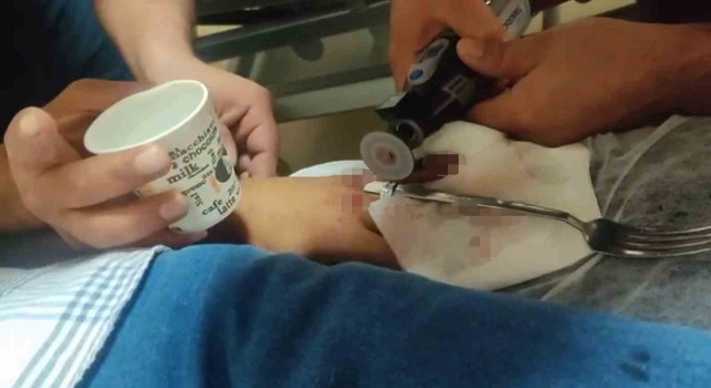 Acil serviste yüzük çıkarma operasyonu