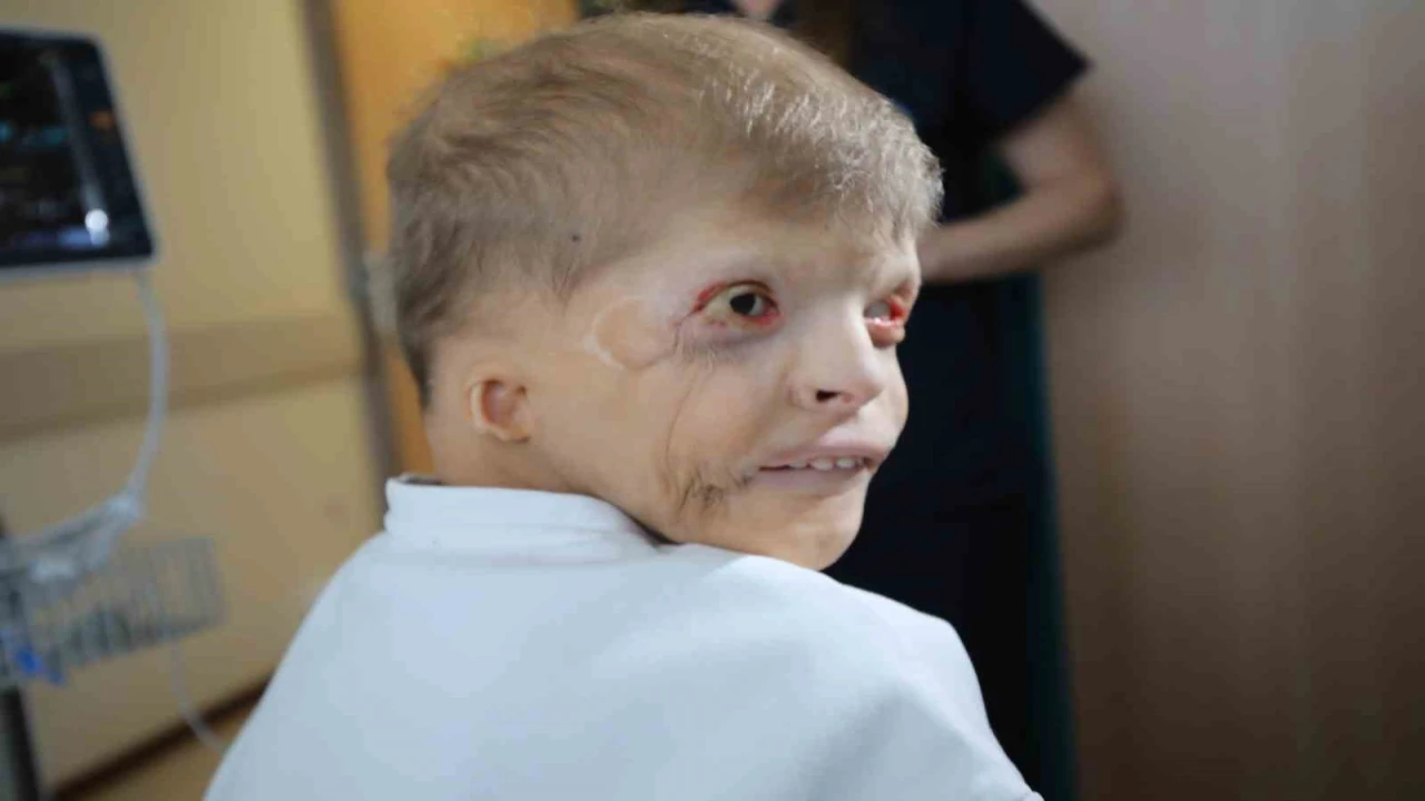 Ukraynalı Myhailonun kulak kepçeleri, Antalyada kaburgalarından yapılacak