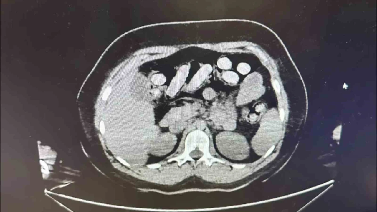1.5 kilo metamfetamin iki kadın kuryenin bağırsak ve midesinden çıktı