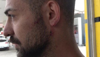 Kavgayı ayırmak isterken kulağından ısırıldı