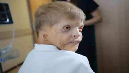 Ukraynalı Myhailonun kulak kepçeleri, Antalyada kaburgalarından yapılacak