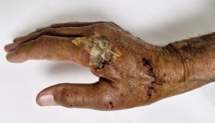 Duşakabin patladı, eline 20ye yakın dikiş atıldı