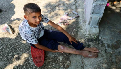 Kaza sonrası ayağı yanlış kaynadı, hayatı kaykay üzerinde geçiyor