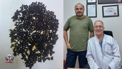 PALMİYE HASTANESİ'NDE BAŞARILI SAFRA KESESİ OPERASYONU