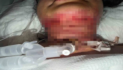 Gıdı estetiği sonrası nefes alamadı, boynundan acil solunum yolu açıldı
