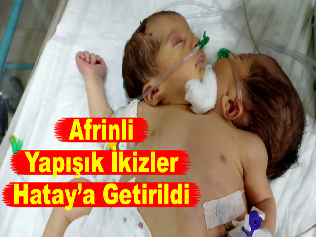 Afrinli Yapışık İkizler Hatay’a Getirildi
